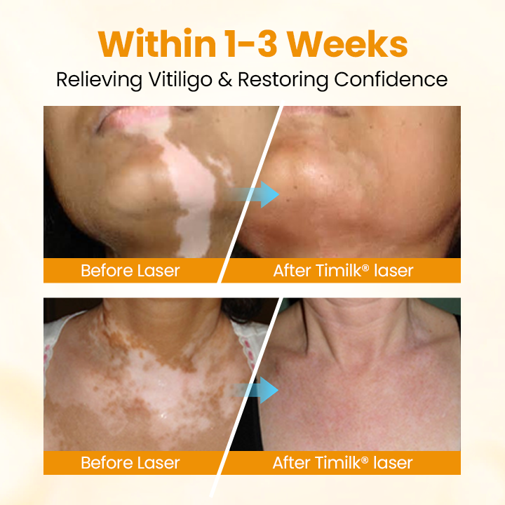 Lovilds® VitiGone Rapid Spray — 2–3 Week Repigmentation with OTDS