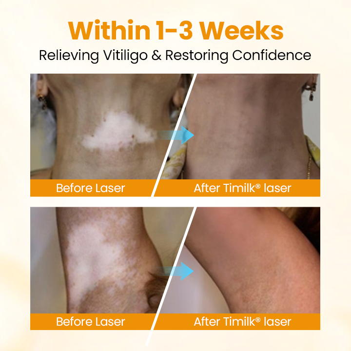 Lovilds® VitiGone Rapid Spray — 2–3 Week Repigmentation with OTDS