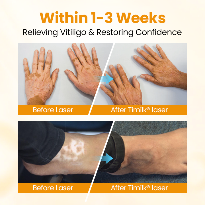Lovilds® VitiGone Rapid Spray — 2–3 Week Repigmentation with OTDS