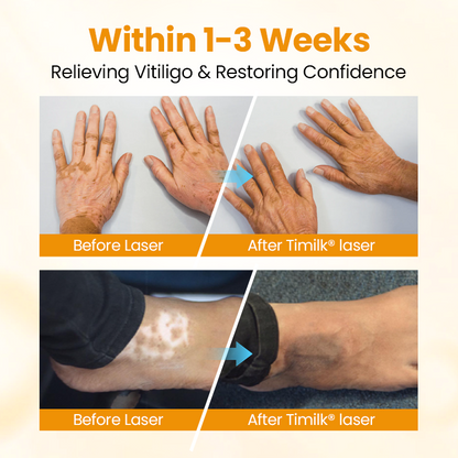 Lovilds® VitiGone Rapid Spray — 2–3 Week Repigmentation with OTDS