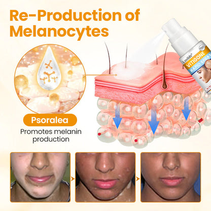 Lovilds® VitiGone Rapid Spray — 2–3 Week Repigmentation with OTDS