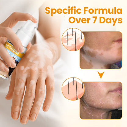 Lovilds® VitiGone Rapid Spray — 2–3 Week Repigmentation with OTDS